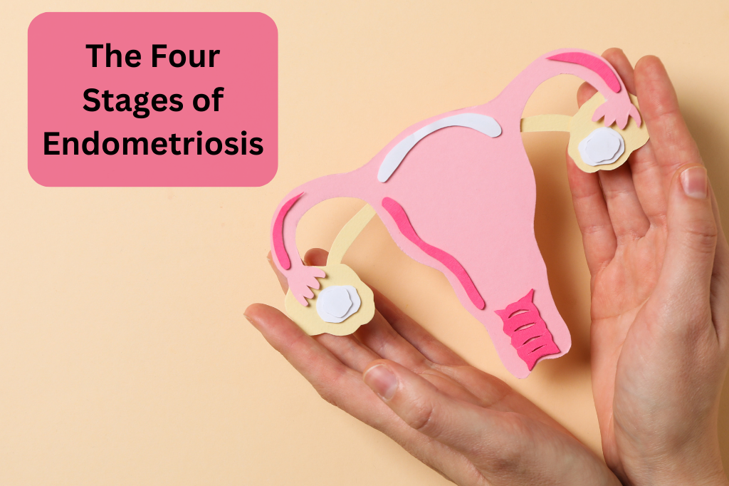 The Four Stages of Endometriosis