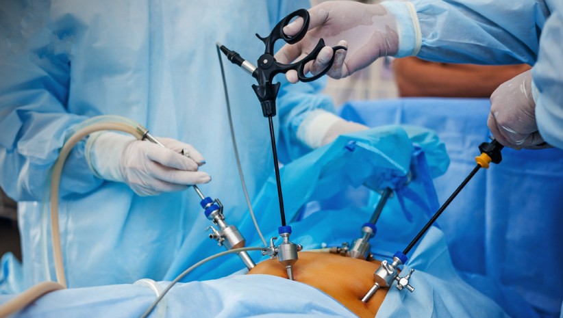 laparoscopic surgery for infertility